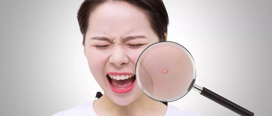 如何有效治疗痘痘？六点建议助你轻松缓解！