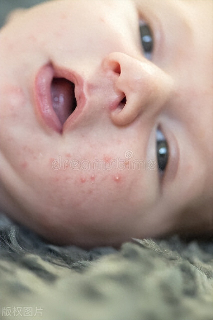 专家教你三招解决宝宝起疹子问题，无需急于用药膏